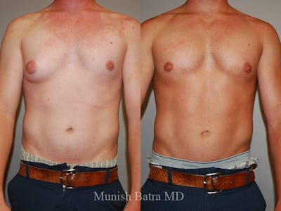 Gynecomastia Before & After Gallery - Patient 377436 - Image 1