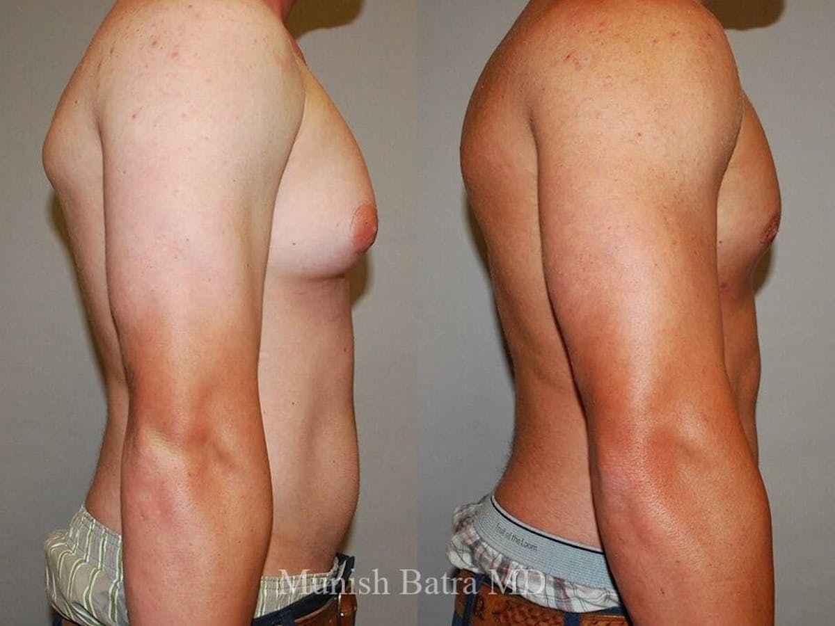 Gynecomastia Before & After Gallery - Patient 377436 - Image 2