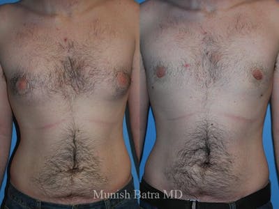 Gynecomastia Before & After Gallery - Patient 682314 - Image 1