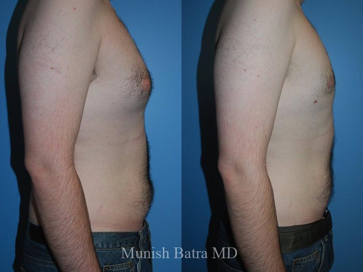 Gynecomastia Before & After Gallery - Patient 682314 - Image 2