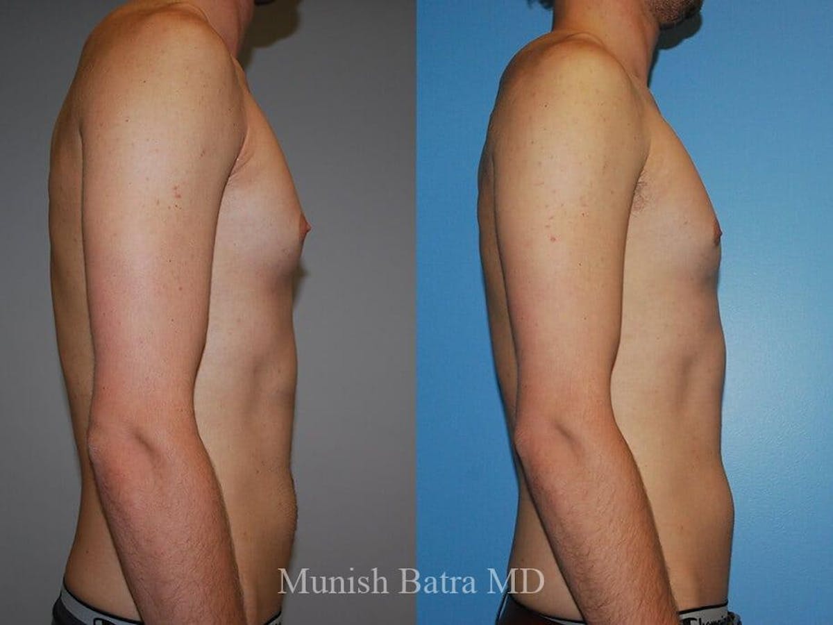 Gynecomastia Before & After Gallery - Patient 287182 - Image 1