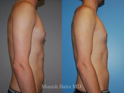 Gynecomastia Before & After Gallery - Patient 287182 - Image 1
