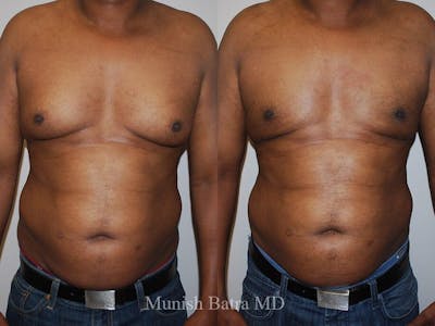 Gynecomastia Before & After Gallery - Patient 366331 - Image 1