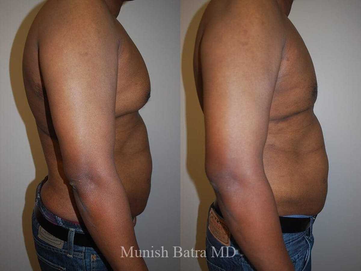 Gynecomastia Before & After Gallery - Patient 366331 - Image 2