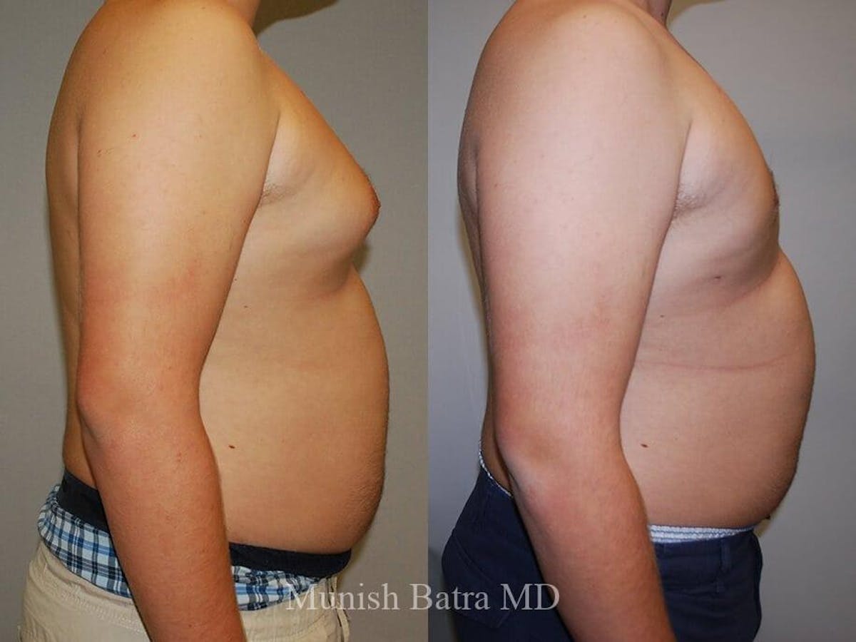 Gynecomastia Before & After Gallery - Patient 373570 - Image 1