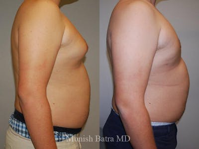 Gynecomastia Before & After Gallery - Patient 373570 - Image 1