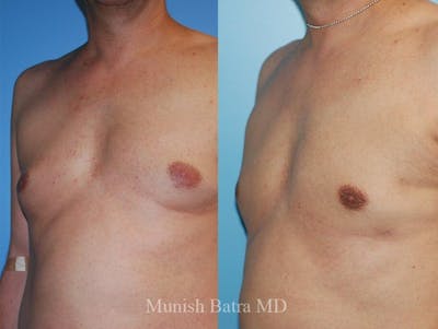 Gynecomastia Before & After Gallery - Patient 180935 - Image 1