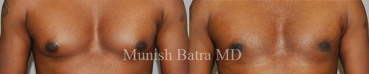 Gynecomastia Before & After Gallery - Patient 178934 - Image 1