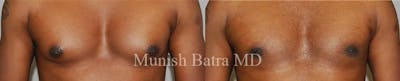 Gynecomastia Before & After Gallery - Patient 178934 - Image 1