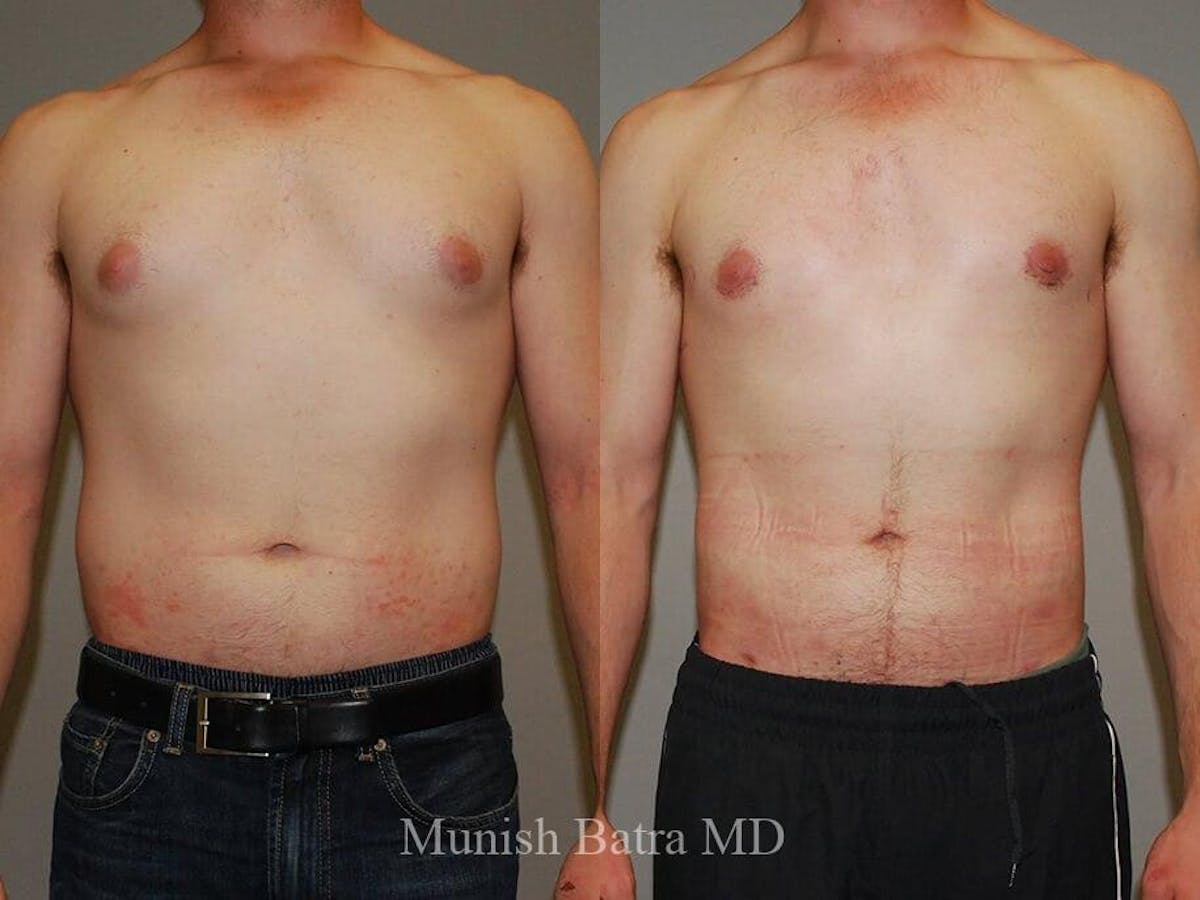 Gynecomastia Before & After Gallery - Patient 341224 - Image 1