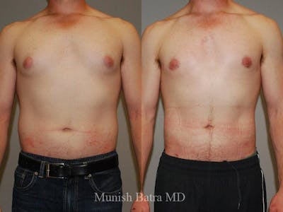 Gynecomastia Before & After Gallery - Patient 341224 - Image 1