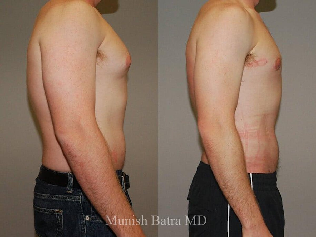 Gynecomastia Before & After Gallery - Patient 341224 - Image 2