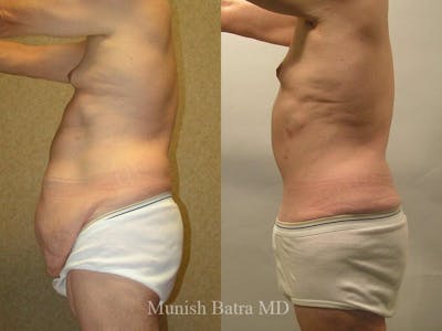 Male Abdominoplasty Before & After Gallery - Patient 856939 - Image 1
