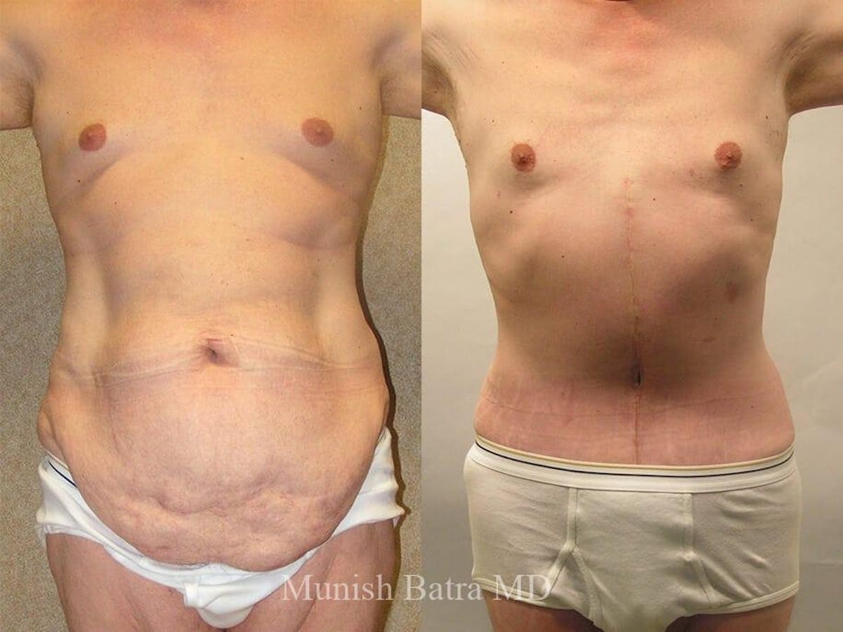 Male Abdominoplasty Before & After Gallery - Patient 856939 - Image 2