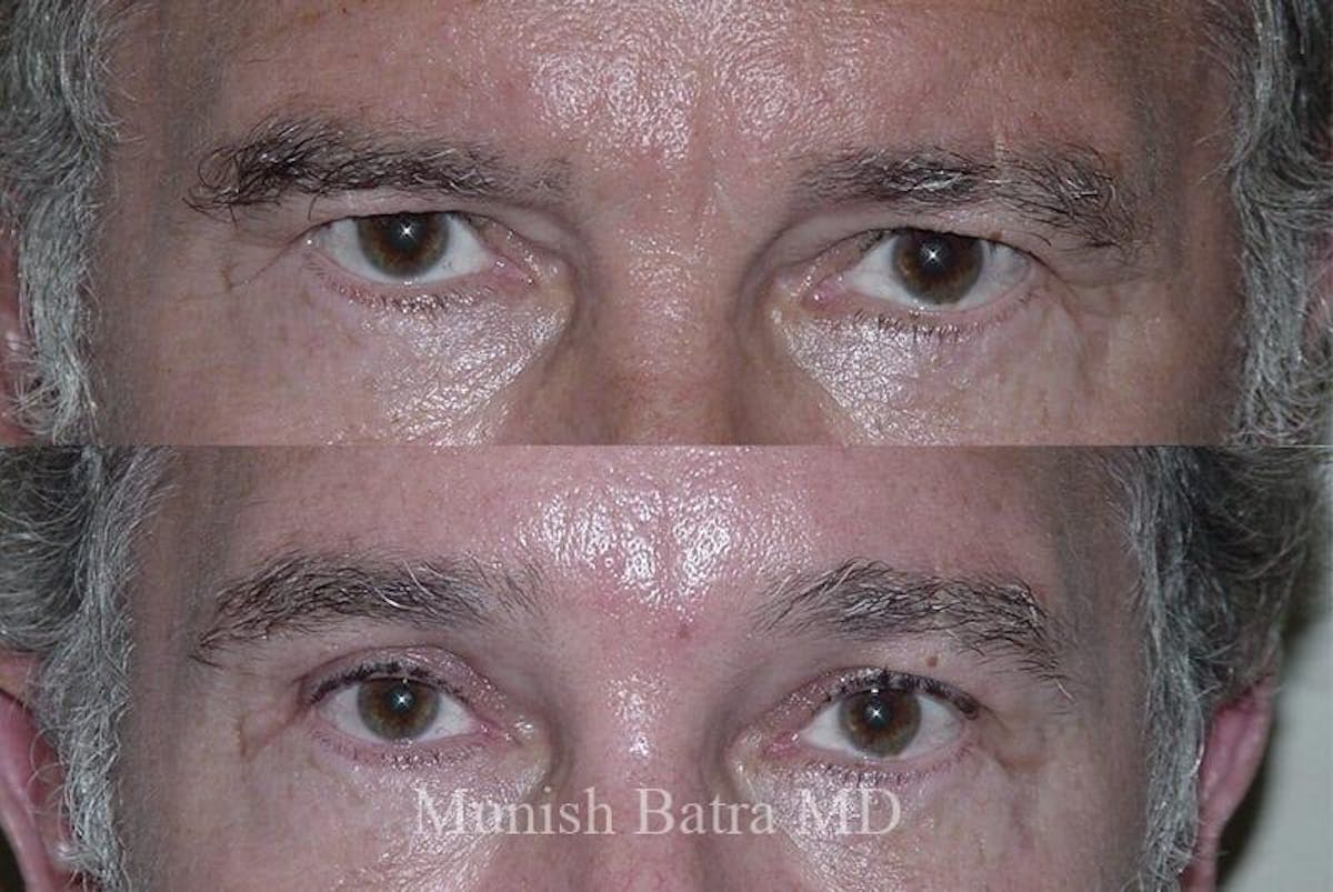 Male Eyelid Surgery Before & After Gallery - Patient 185807 - Image 1