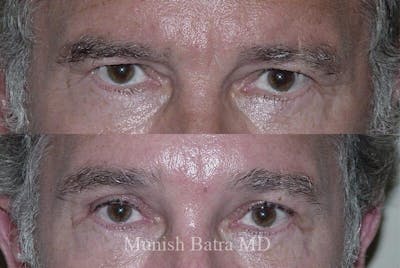 Male Eyelid Surgery Before & After Gallery - Patient 185807 - Image 1