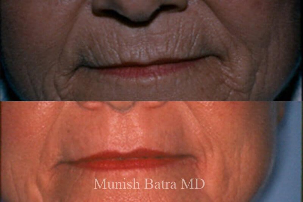 Fraxel Laser Before & After Gallery - Patient 240949 - Image 1