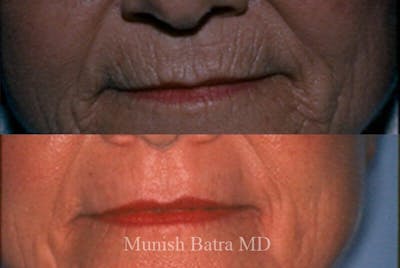 Fraxel Laser Before & After Gallery - Patient 240949 - Image 1