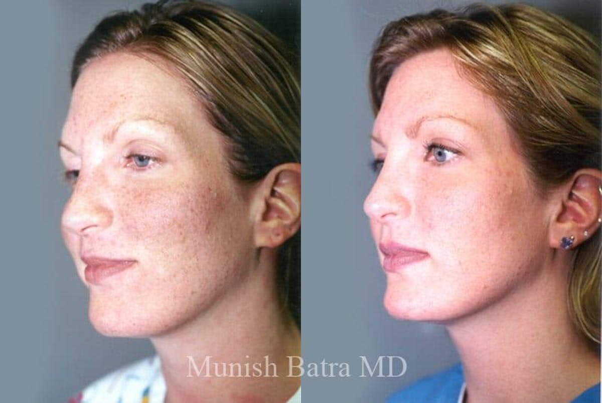 Fraxel Laser Before & After Gallery - Patient 100029 - Image 1