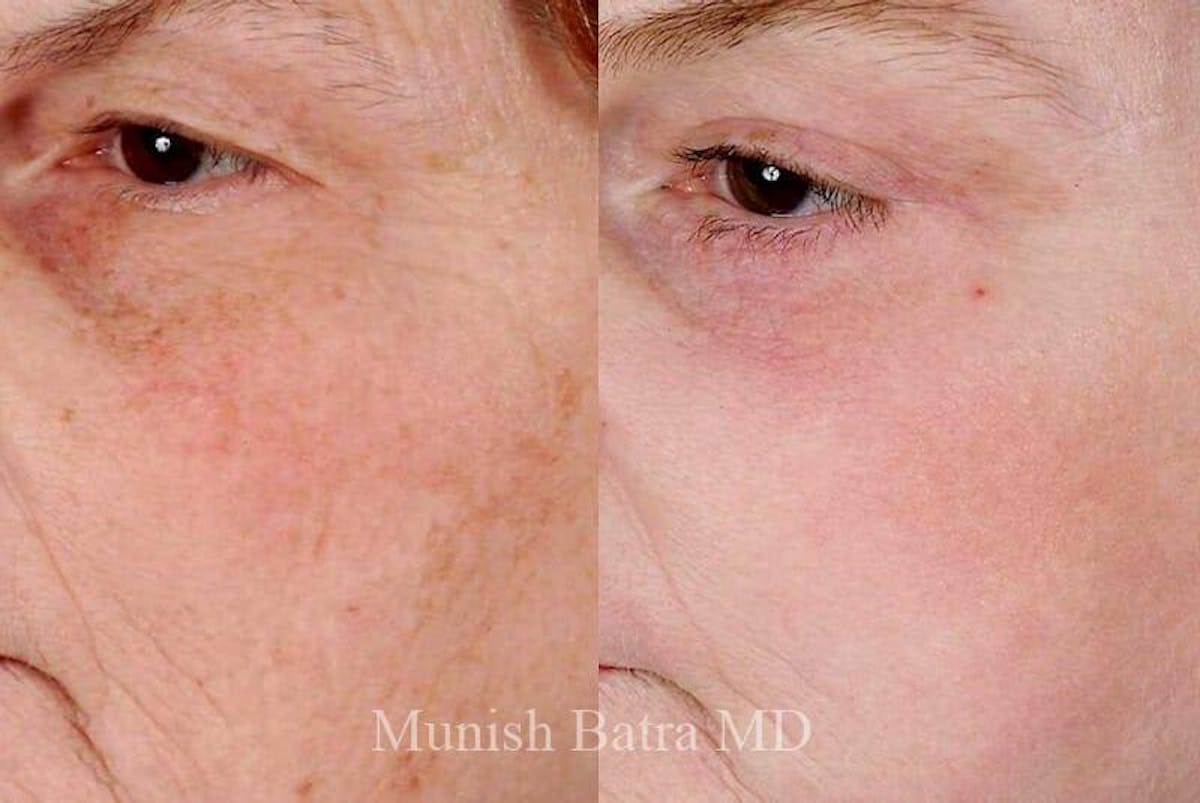 Fraxel Laser Before & After Gallery - Patient 160620 - Image 1