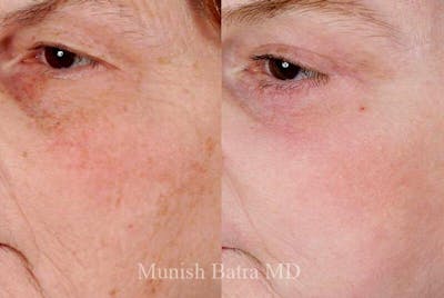 Fraxel Laser Before & After Gallery - Patient 160620 - Image 1
