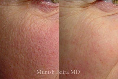 Fraxel Laser Before & After Gallery - Patient 100938 - Image 1