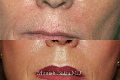 Fraxel Laser Before & After Gallery - Patient 427799 - Image 1