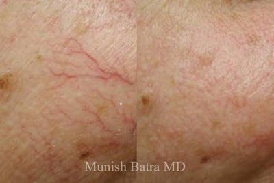 Fraxel Laser Before & After Gallery - Patient 402103 - Image 1