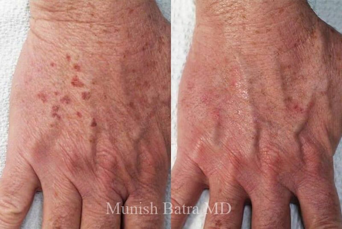 Fraxel Laser Before & After Gallery - Patient 189057 - Image 1