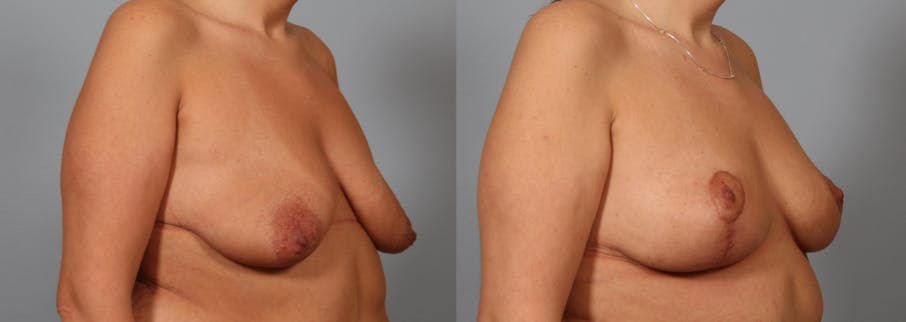 breast lift patient results