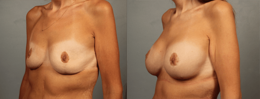 breast lift patient results