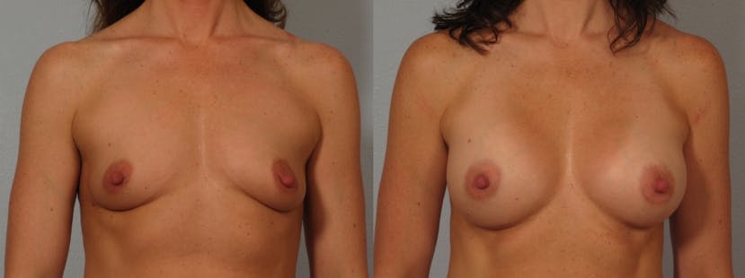 breast lift patient results