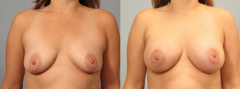 breast lift patient results