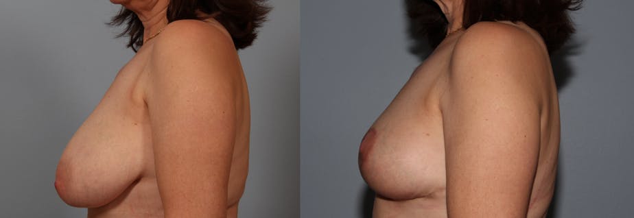 breast lift patient results