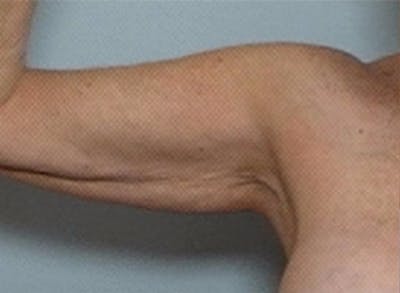 Arm Contouring Before & After Gallery - Patient 205093 - Image 1