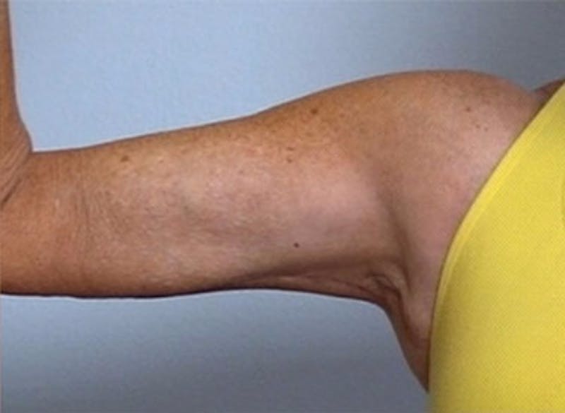 Arm Contouring Before & After Gallery - Patient 205093 - Image 2