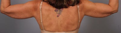 Arm Contouring Before & After Gallery - Patient 426305 - Image 1