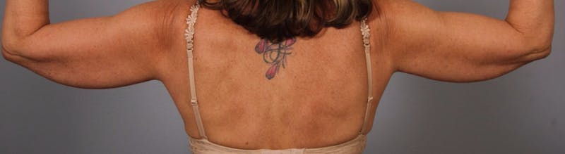 Arm Contouring Before & After Gallery - Patient 426305 - Image 1