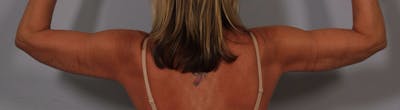 Arm Contouring Before & After Gallery - Patient 426305 - Image 2