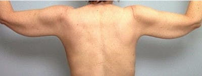 Arm Contouring Before & After Gallery - Patient 413242 - Image 1