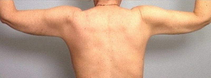 Arm Contouring Before & After Gallery - Patient 413242 - Image 2