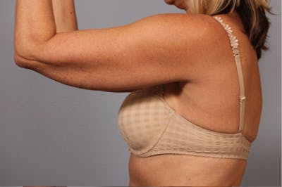 Arm Contouring Before & After Gallery - Patient 710106 - Image 1