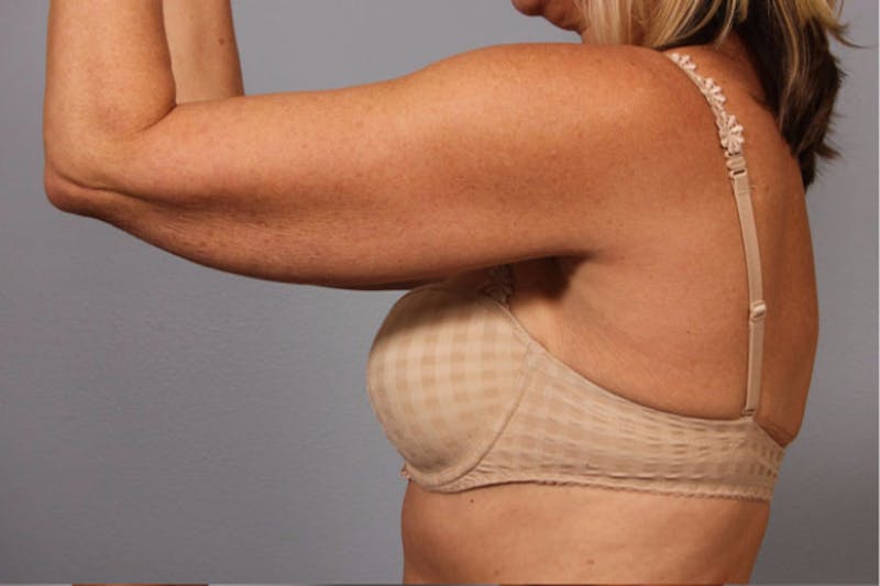 Arm Contouring Before & After Gallery - Patient 710106 - Image 1