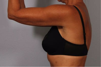 Arm Contouring Before & After Gallery - Patient 710106 - Image 2