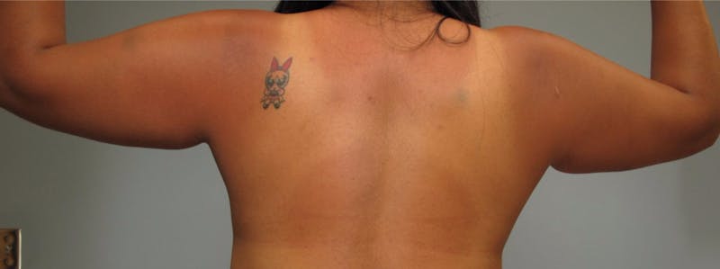 Arm Contouring Before & After Gallery - Patient 381282 - Image 1
