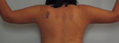 Arm Contouring Before & After Gallery - Patient 381282 - Image 2