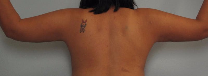 Arm Contouring Before & After Gallery - Patient 381282 - Image 2