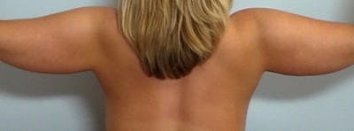 Arm Contouring Before & After Gallery - Patient 259886 - Image 1