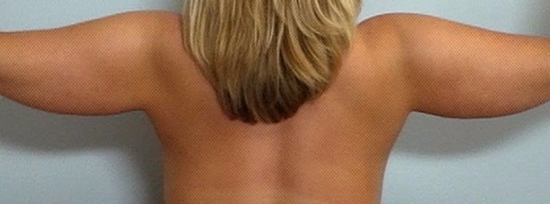 Arm Contouring Before & After Gallery - Patient 259886 - Image 1