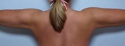 Arm Contouring Before & After Gallery - Patient 259886 - Image 2